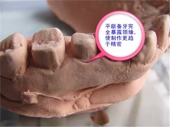 備牙應(yīng)注意的事項(xiàng)+備牙取摸損傷牙齦問題 備牙應(yīng)注意的事項(xiàng)+備牙取摸損傷牙齦問題