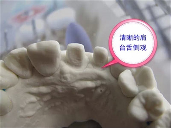 備牙應(yīng)注意的事項(xiàng)+備牙取摸損傷牙齦問題 備牙應(yīng)注意的事項(xiàng)+備牙取摸損傷牙齦問題