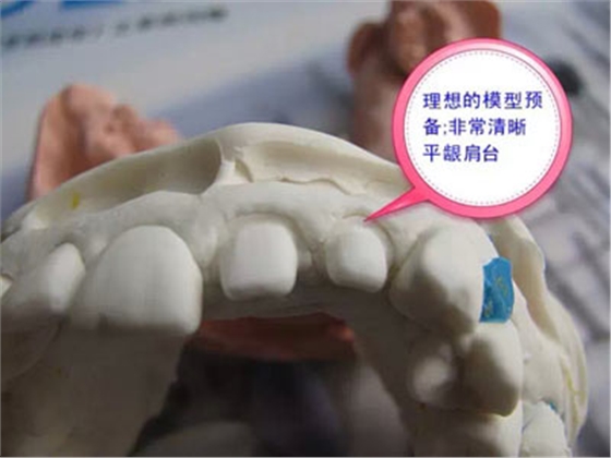 備牙應(yīng)注意的事項(xiàng)+備牙取摸損傷牙齦問題 備牙應(yīng)注意的事項(xiàng)+備牙取摸損傷牙齦問題