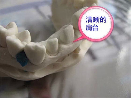 備牙應(yīng)注意的事項(xiàng)+備牙取摸損傷牙齦問題 備牙應(yīng)注意的事項(xiàng)+備牙取摸損傷牙齦問題