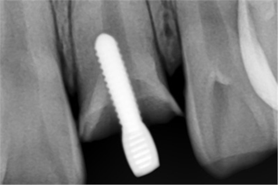 根管側(cè)穿修補(bǔ)方法 根管側(cè)穿修補(bǔ)方法