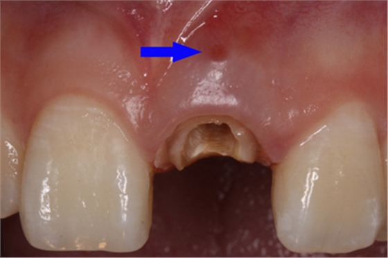 根管側(cè)穿修補(bǔ)方法 根管側(cè)穿修補(bǔ)方法