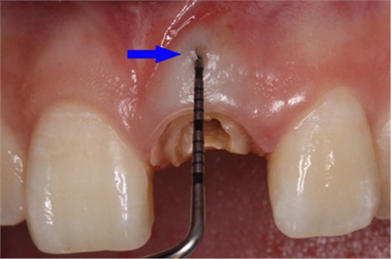 根管側(cè)穿修補(bǔ)方法 根管側(cè)穿修補(bǔ)方法
