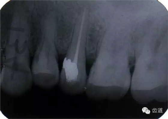 根管治療的并發(fā)癥及處理 根管治療的并發(fā)癥及處理