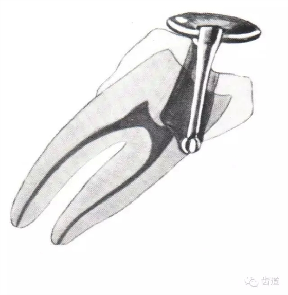 根管治療的并發(fā)癥及處理 根管治療的并發(fā)癥及處理