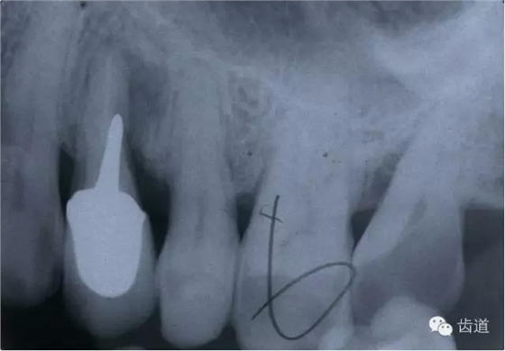根管治療的并發(fā)癥及處理 根管治療的并發(fā)癥及處理