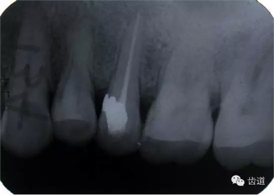 根管治療的并發(fā)癥及處理 根管治療的并發(fā)癥及處理