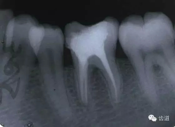 根管治療的并發(fā)癥及處理 根管治療的并發(fā)癥及處理