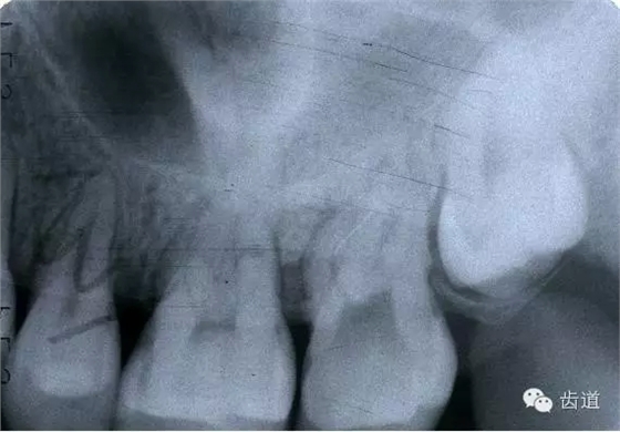 根管治療的并發(fā)癥及處理 根管治療的并發(fā)癥及處理