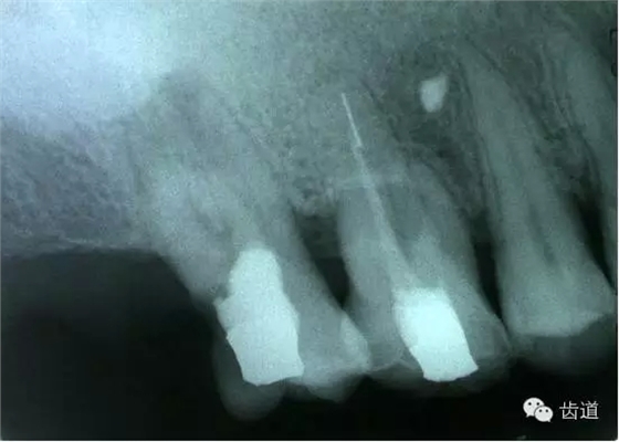 根管治療的并發(fā)癥及處理 根管治療的并發(fā)癥及處理