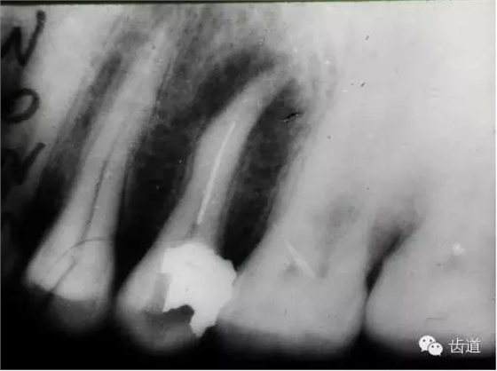根管治療的并發(fā)癥及處理 根管治療的并發(fā)癥及處理