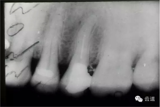 根管治療的并發(fā)癥及處理 根管治療的并發(fā)癥及處理