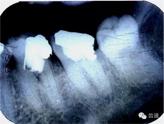 根管治療的并發(fā)癥及處理 根管治療的并發(fā)癥及處理