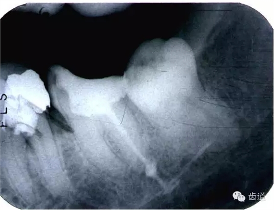 根管治療的并發(fā)癥及處理 根管治療的并發(fā)癥及處理