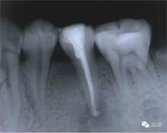 根管治療的并發(fā)癥及處理 根管治療的并發(fā)癥及處理