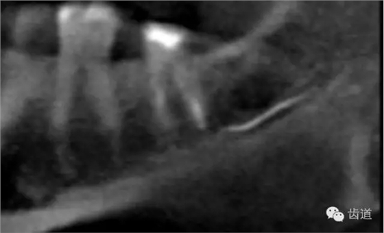 根管治療的并發(fā)癥及處理 根管治療的并發(fā)癥及處理