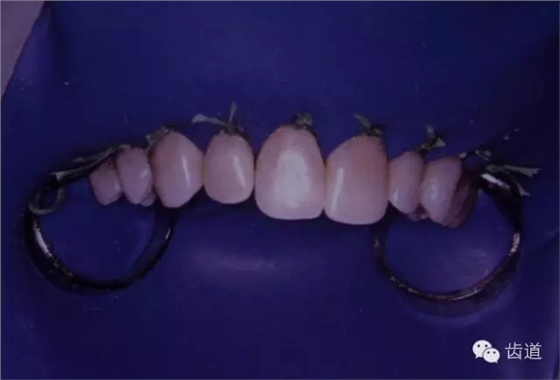 根管治療的并發(fā)癥及處理 根管治療的并發(fā)癥及處理