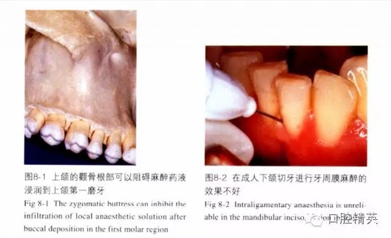 分析局部麻醉失敗的常見原因 分析局部麻醉失敗的常見原因