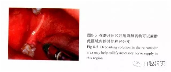 分析局部麻醉失敗的常見原因 分析局部麻醉失敗的常見原因