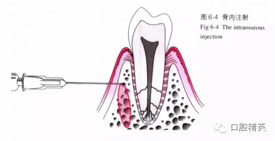 分析局部麻醉失敗的常見原因 分析局部麻醉失敗的常見原因