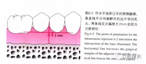 分析局部麻醉失敗的常見原因 分析局部麻醉失敗的常見原因