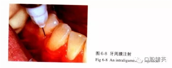 分析局部麻醉失敗的常見原因 分析局部麻醉失敗的常見原因