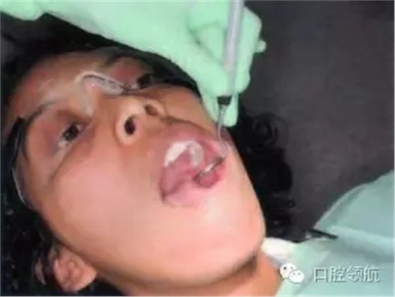 防霧化吸唾口鏡 防霧化吸唾口鏡