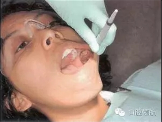 防霧化吸唾口鏡 防霧化吸唾口鏡