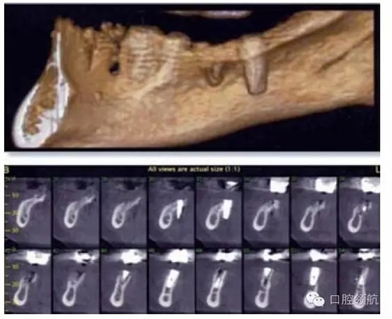 種植體失敗的病因和危險因素 種植體失敗的病因和危險因素