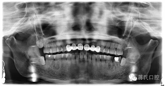 蔣氏口腔醫(yī)師風(fēng)采系列報道(五)左下六七即拔即種病歷分享 蔣氏口腔醫(yī)師風(fēng)采系列報道(五)左下六七即拔即種病歷分享