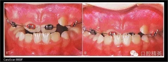 解決牙齒不齊的十八般武器 解決牙齒不齊的十八般武器