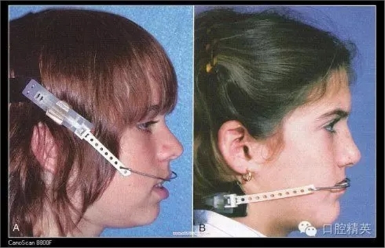 解決牙齒不齊的十八般武器 解決牙齒不齊的十八般武器