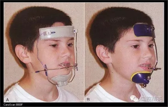 解決牙齒不齊的十八般武器 解決牙齒不齊的十八般武器