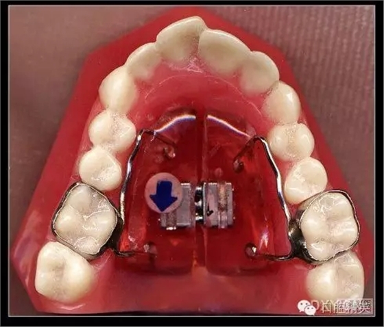 解決牙齒不齊的十八般武器 解決牙齒不齊的十八般武器