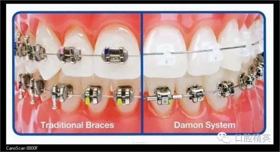 解決牙齒不齊的十八般武器 解決牙齒不齊的十八般武器