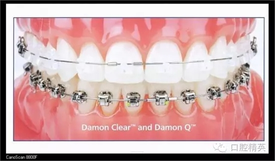 解決牙齒不齊的十八般武器 解決牙齒不齊的十八般武器