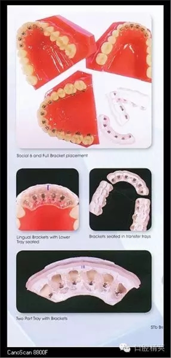 解決牙齒不齊的十八般武器 解決牙齒不齊的十八般武器