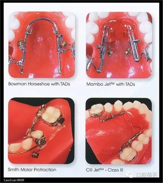 解決牙齒不齊的十八般武器 解決牙齒不齊的十八般武器