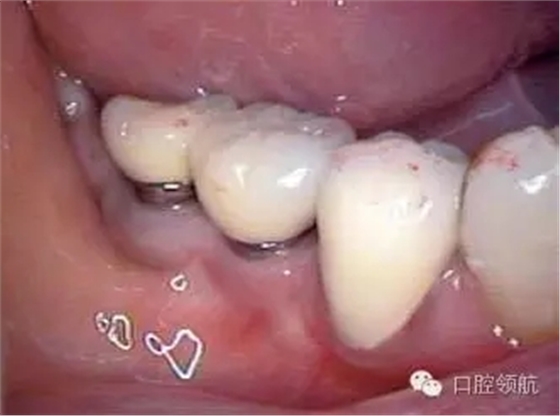 種植體周圍出現(xiàn)伴有骨密度增加現(xiàn)象的骨吸收 種植體周圍出現(xiàn)伴有骨密度增加現(xiàn)象的骨吸收