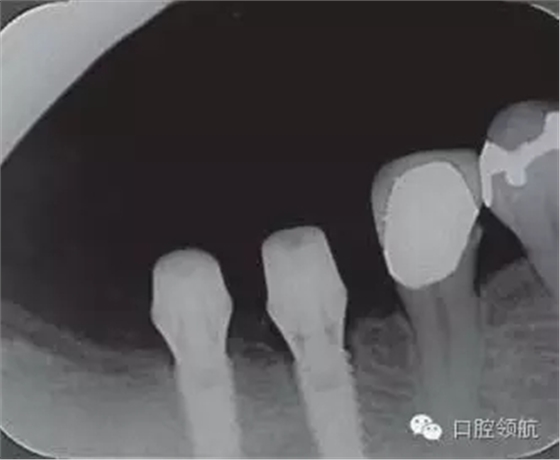 種植體周圍出現(xiàn)伴有骨密度增加現(xiàn)象的骨吸收 種植體周圍出現(xiàn)伴有骨密度增加現(xiàn)象的骨吸收