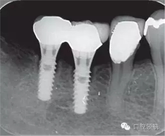 種植體周圍出現(xiàn)伴有骨密度增加現(xiàn)象的骨吸收 種植體周圍出現(xiàn)伴有骨密度增加現(xiàn)象的骨吸收