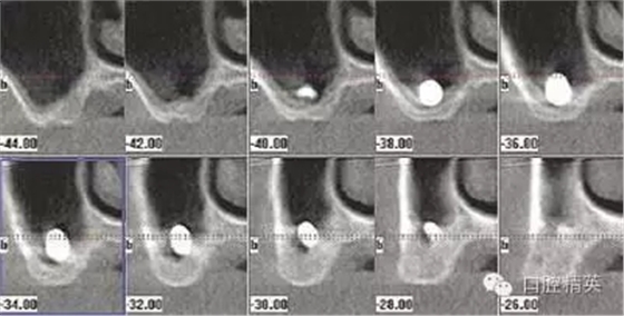 口腔種植各種失敗模式的病因探查 口腔種植各種失敗模式的病因探查
