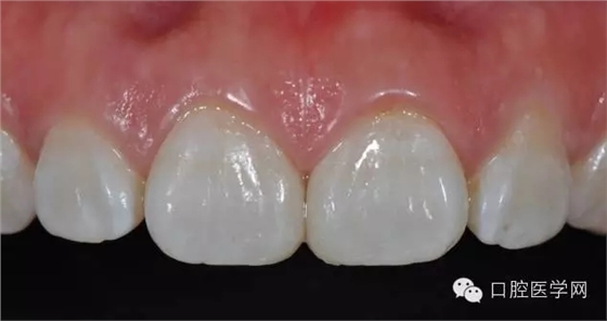 樹脂關閉前牙間隙