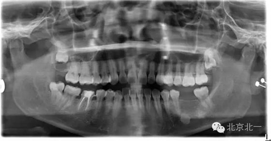 種植遇到骨島怎么辦 種植遇到骨島怎么辦
