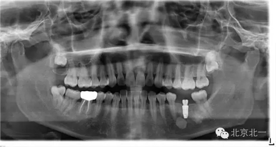 種植遇到骨島怎么辦 種植遇到骨島怎么辦