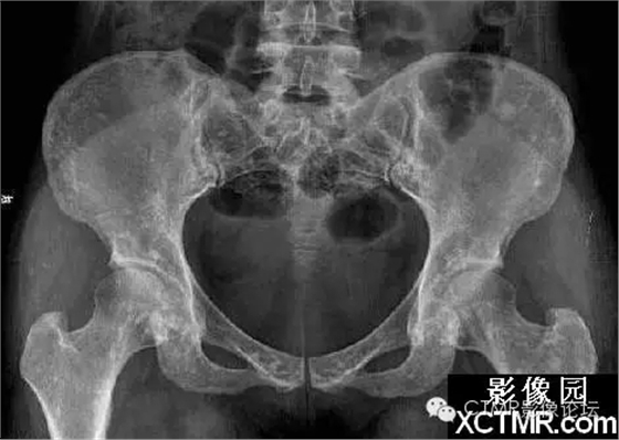 種植遇到骨島怎么辦 種植遇到骨島怎么辦