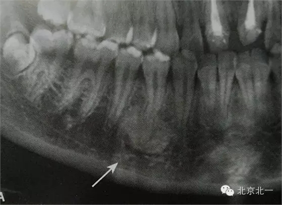 種植遇到骨島怎么辦 種植遇到骨島怎么辦