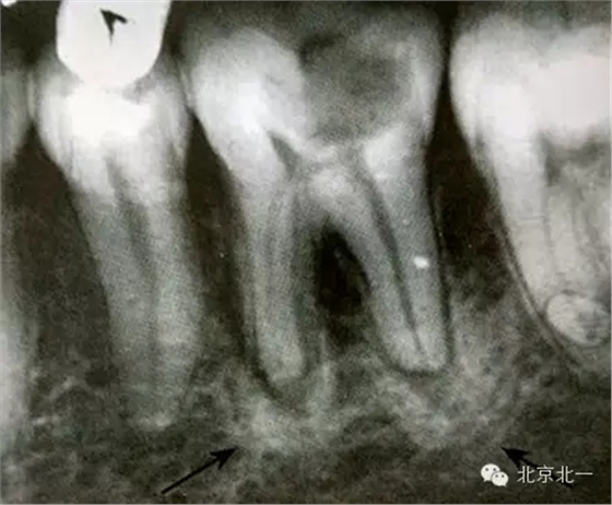 種植遇到骨島怎么辦 種植遇到骨島怎么辦