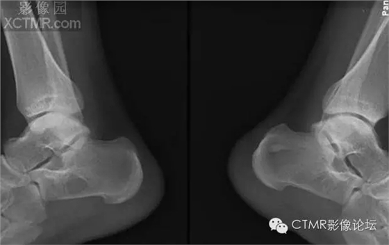 種植遇到骨島怎么辦 種植遇到骨島怎么辦