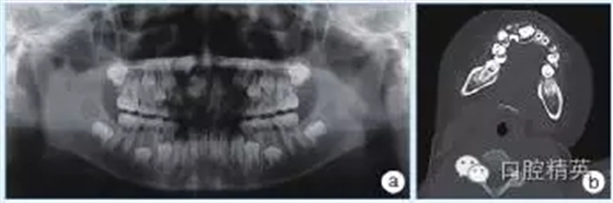 頜骨良性成牙骨質(zhì)細胞瘤 頜骨良性成牙骨質(zhì)細胞瘤